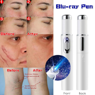 Lápiz láser de acné/terapia de luz azul/dispositivo de tratamiento de arrugas suaves