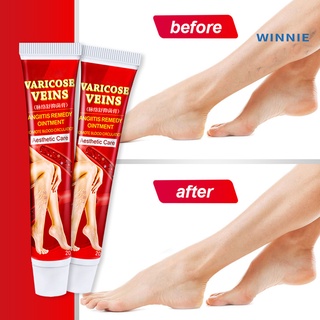 [Winnie] 20g Varicose Veins Treatment Cream Safe Gentle Anti Inflammation Effective Angiitis Cream for Phlebitis