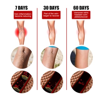 ankaina natural varices venas vasculares tratamiento de bulto crema calmante alivio piernas cuidado (3)