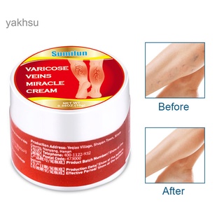 Yak_crema Varizes Ointmnet varicosables Vasculitis Flebitis parche araña ajustada piel Para Adulto (9)