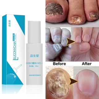 10ml tratamiento de uñas hongo onicomicosis líquido antibacteriano desinfección de uñas tratamiento de hongos manicura herramientas de tratamiento