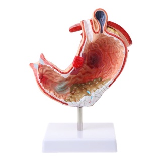 sa anatomía anatómica humana estómago modelo médico patológico gástrico úlcera úlcera médica enseñanza médica herramienta de aprendizaje