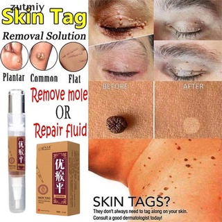 [ZUYM] Skin Tag Remover Against Mole & Genital Wart fast Removal Anti Foot Corn DZX