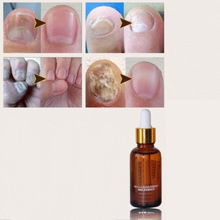 chaiopi uñas hongo onicomicosis eliminación del dedo del pie reparación esencia tratamiento líquido aceite