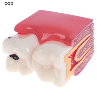 [COD] Dental Teeth Model 6 Times Caries Comparation Study Denture Tooth Models HOT