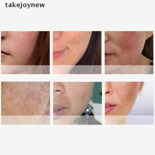 [takejoynew] crema de pecas blanqueadora eliminar melasma acné mancha pigmento melanina manchas oscuras