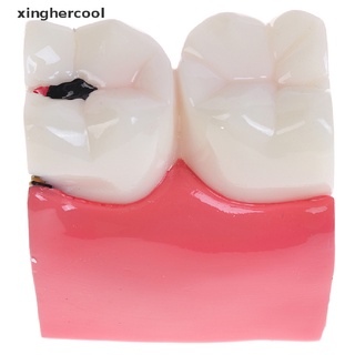 [xinghercool] modelo de dientes dentales 6 veces caries comparation estudio dentadura dental modelos calientes