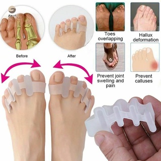 2 pares separador del dedo del pie hallux valgus ortopédico del pulgar juanete superpuesto del dedo del pie corrector cuidado del pie (1)