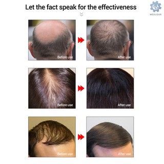 LANBENA 20ml esencia de crecimiento del cabello rápido potente cuidado del cabello aceite esencial tratamiento líquido prevenir la pérdida del cabello (4)