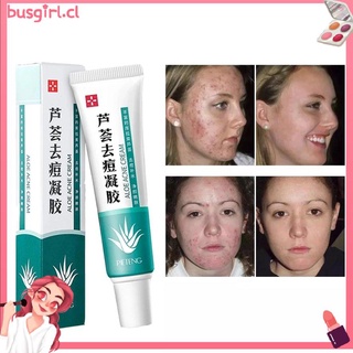 ♚ Effective Acne Removal Cream Acne Treatment Fading Acne Spots Acne Cream