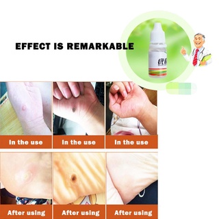 ❀ifashion1❀Skin Tag Remover Foot Corn Removal Plantar Genital Wart Ointment Cream 10mL (6)