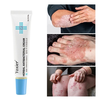 Anti-Sting Cream Eczema Urticaria Peeling Treatment Antibacterial Cream 20g