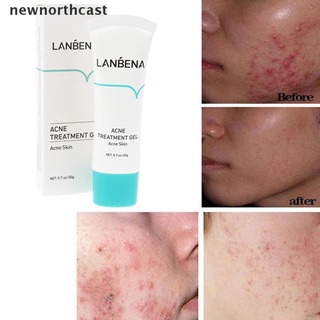 [newnorthcast] tratamiento del acné crema blanqueamiento de puntos negros gel control de aceite retráctil cicatriz de poros