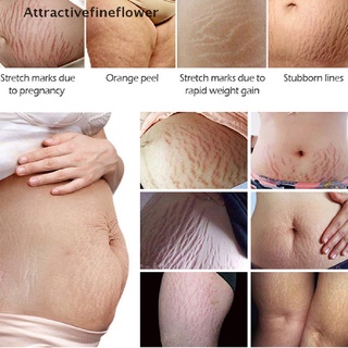 [aff] crema de piel suave para reparación de la piel de maternidad para estrías/cuidado de eliminación de cicatrices