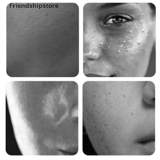 [friendshipstore] máscara limpiadora acné limpieza profunda belleza piel hidratante blanqueamiento helado cl (1)