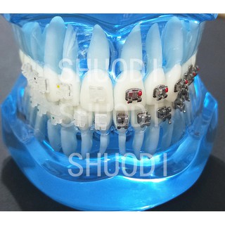 Modelo de ortodoncia dental con soportes de cerámica y Metal (izquierda derecha)