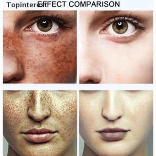 [topinterest] corrector de manchas oscuras crema facial anti-envejecimiento blanqueamiento hidratante remove.