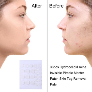 inlove 24pcs hydrocolloid invisible parche de acné cara espinillas eliminación de manchas (1)