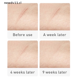 newd crema de eliminación de cicatrices de acné gel cicatrizante reparación de la piel crema facial acné manchas acné cl (7)