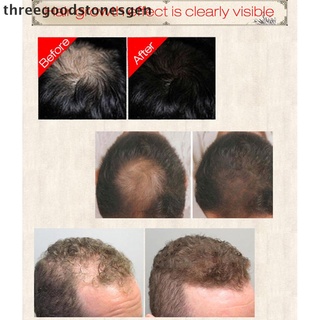 [threegoodstonesgen] sevich pelo barba crecimiento esencia spray 30ml anti pérdida de cabello nutrir el crecimiento del cabello (1)