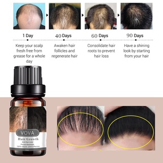 engfeimi 10ml equilibrio de aceite para el cabello secreción de sebo multifuncional extractos de plantas de crecimiento del cabello esencia del cuero cabelludo para salón (4)