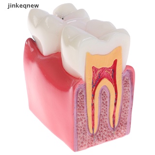 jncl modelo de dientes dentales 6 veces caries comparation estudio dentadura dental modelos jnn