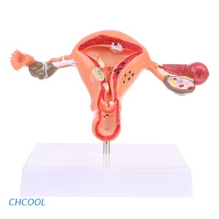 Chcool Útero Patológico Ovario Modelo Anatómico Anatomía Sección Transversal Herramienta De Estudio (1)