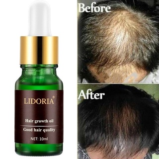 Anti Hair Loss Treatments Regrowth Natural Extract Oil Products for Men Women