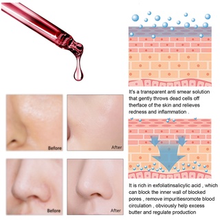 anti acné exfoliante suero facial peeling solución de poros encogimiento suero control de aceite reafirmante hidratante reparación smoot abbacy (7)