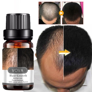 engfeimi 10ml equilibrio de aceite para el cabello secreción de sebo multifuncional extractos de plantas de crecimiento del cabello esencia del cuero cabelludo para salón
